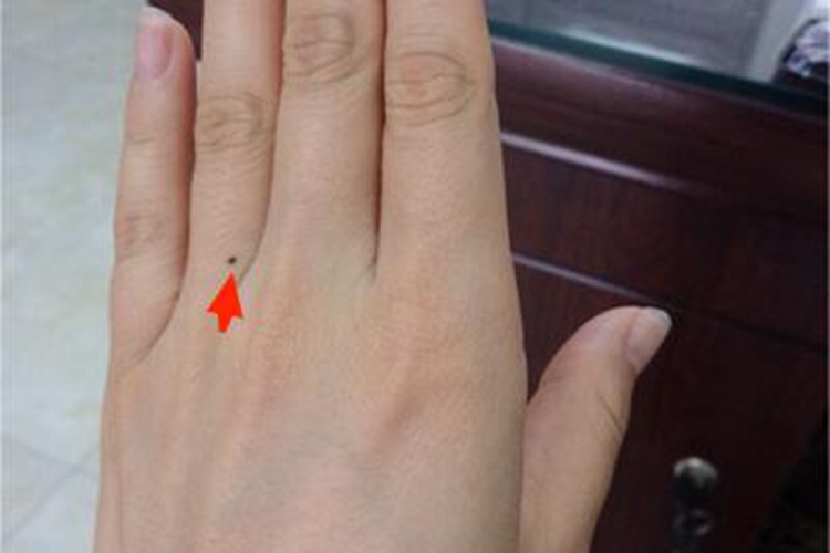 交界痣无名指有黑点图