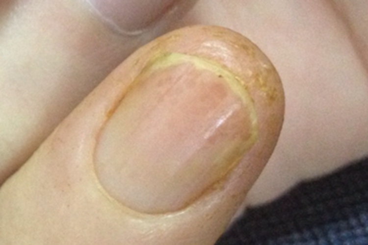 酪氨酸血症手指尖皮肤粗糙图