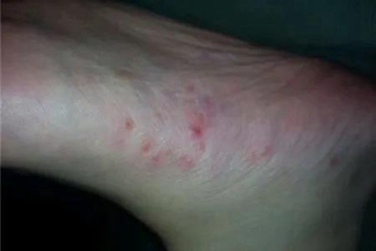 湿疹脚底丘疹图