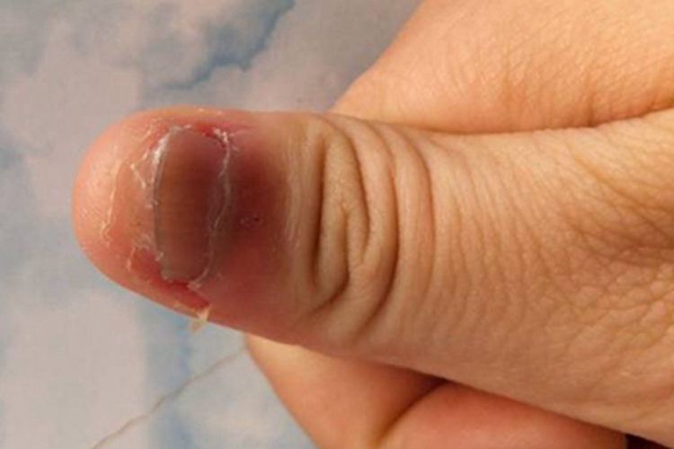 慢性甲沟炎脱皮图