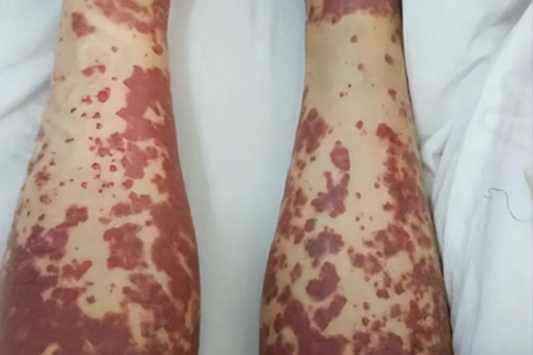 重症多形红斑小腿症状图