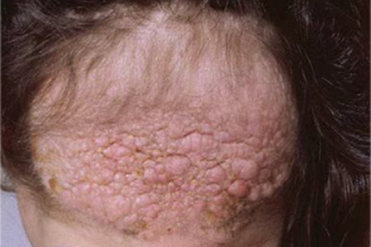 结缔组织痣头皮有成片疙瘩图 结缔组织痣头皮有成片疙瘩图