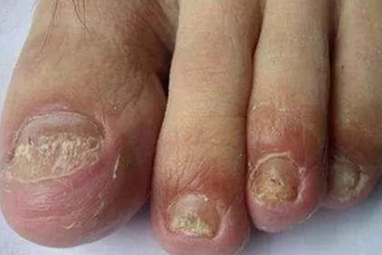 指甲萎缩脚趾甲图