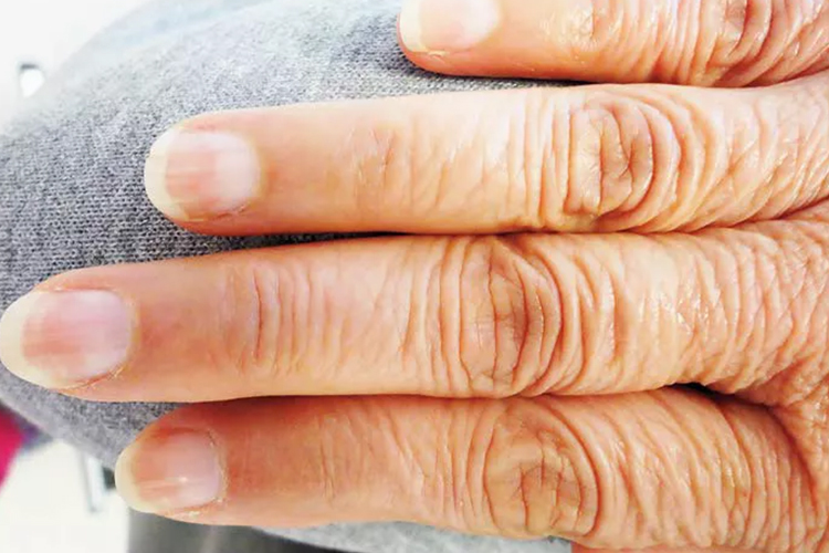 肾病指甲的症状图