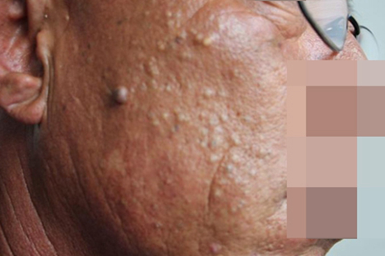 老年性皮脂腺增生疙瘩图