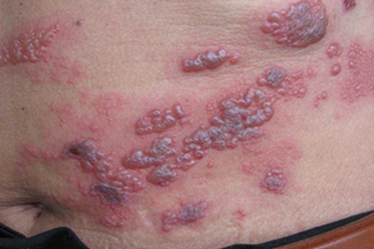 艾滋病窗口期带状疱疹图 艾滋病窗口期带状疱疹图