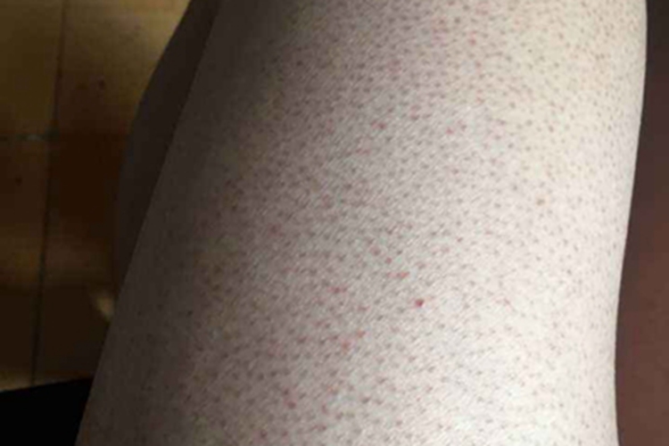 毛发苔藓大腿小疙瘩图