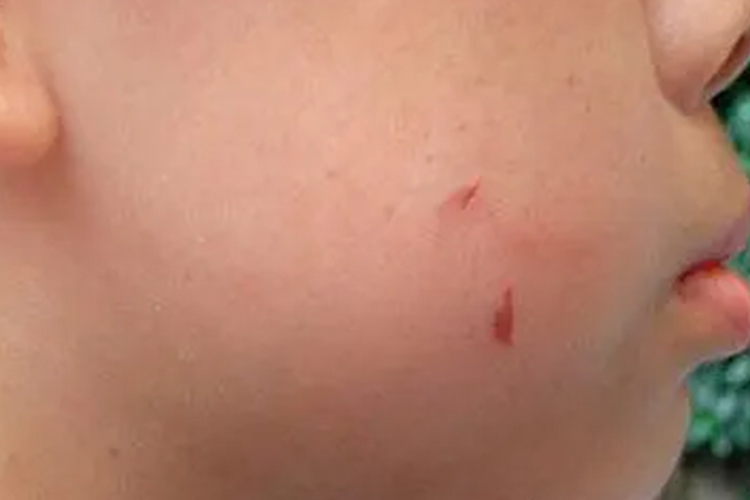 点状指甲抓痕图