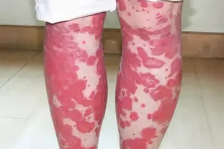 红皮病急性期小腿症状图