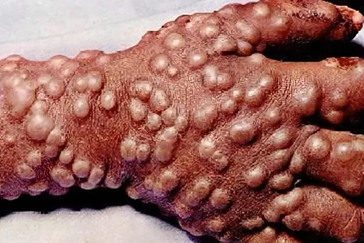 天花手部脓疱图