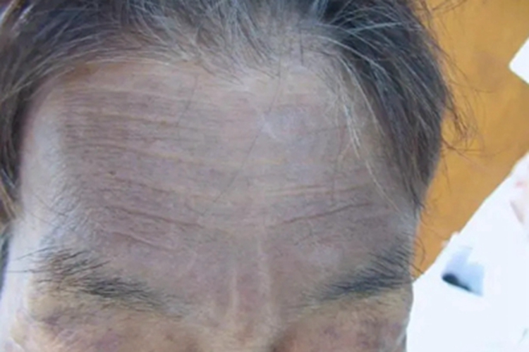 瑞尔黑变病额头变黑图