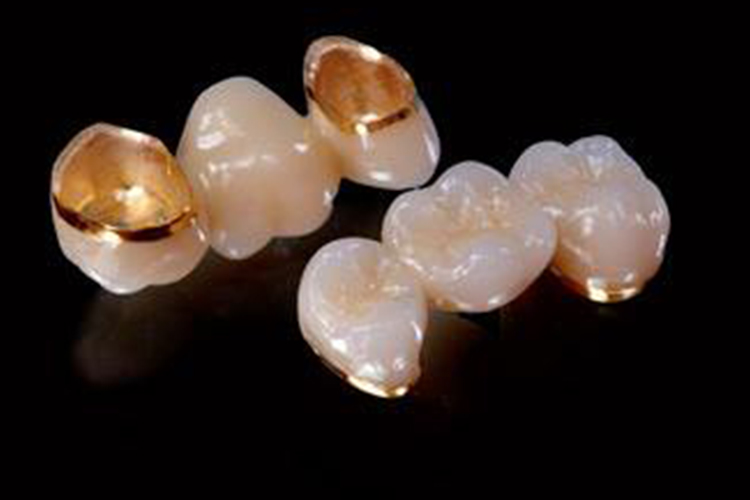黄金烤瓷牙图