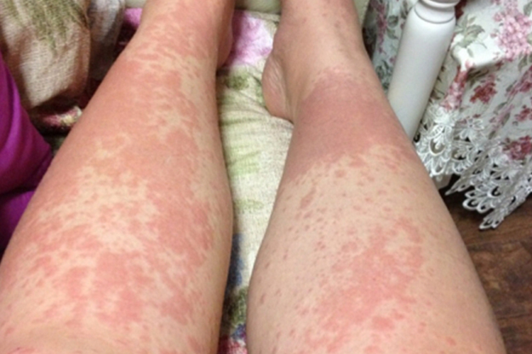 下肢急性自发性荨麻疹图