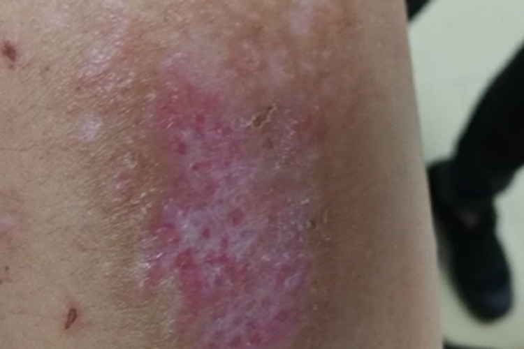 自身敏感性皮炎腿部症状图