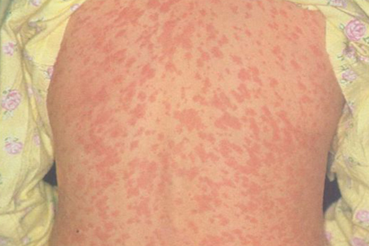 猩红热红疹图