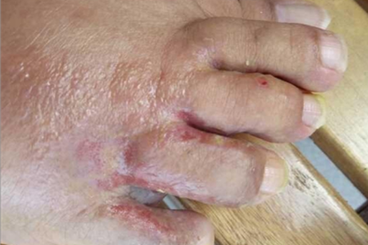 癣菌疹脚趾缝水疱图