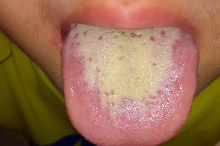 小孩上火舌头图