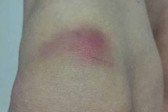 腿摔伤第一天挫伤图