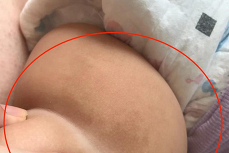 咖啡斑大腿斑图