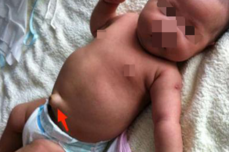 小儿脐疝肚脐突出肿块图