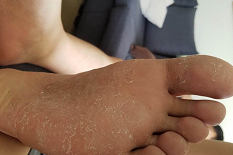 Ⅰ度皮肤皲裂症状图