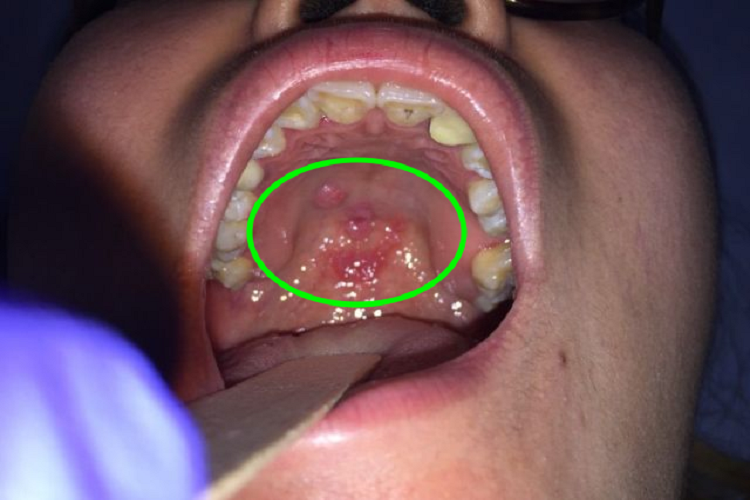 口腔梅毒咽峡红斑图 口腔梅毒咽峡红斑图