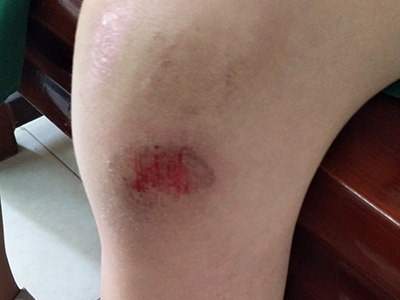 跌伤膝盖上一大块圆形的擦痕伴有渗血图.jpg