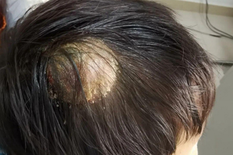 头癣头部症状图