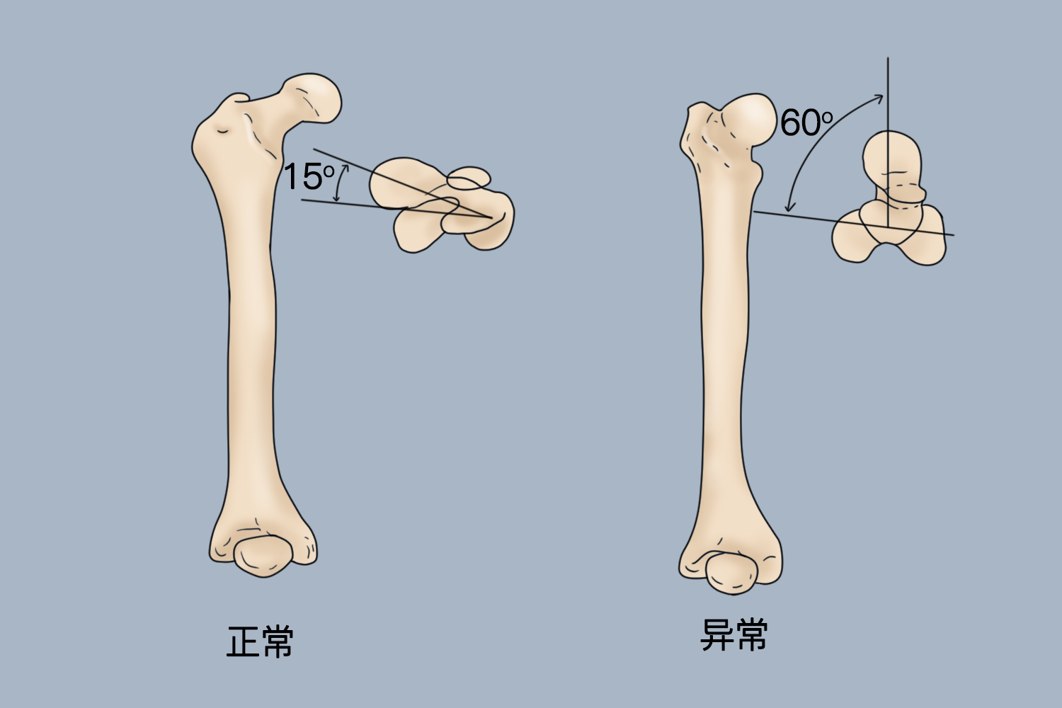 股骨颈前倾角示意图