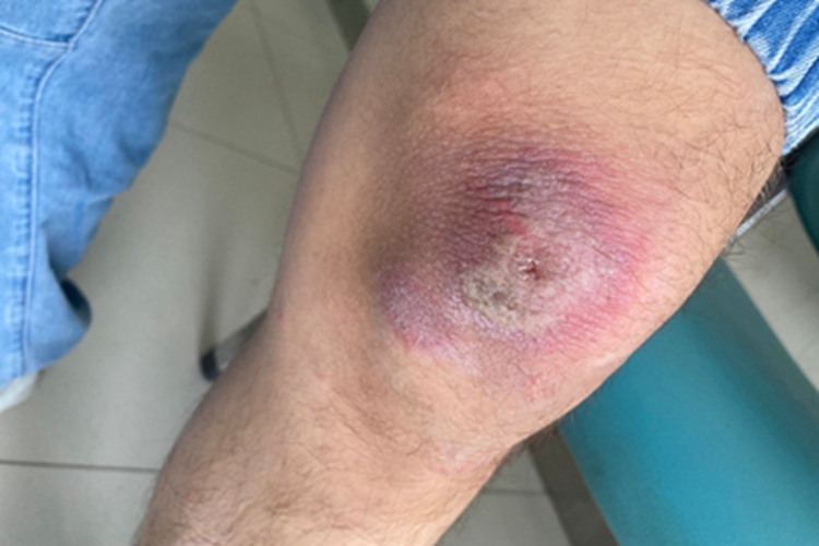 昆虫性皮炎糜烂图