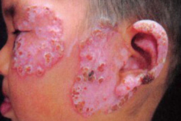 念珠菌性肉芽肿面部红斑图