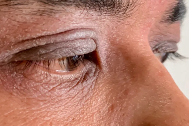 慢性眼睑湿疹眼睑皮肤发黑图