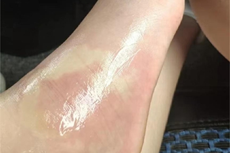 蚊虫叮咬脚背红肿图