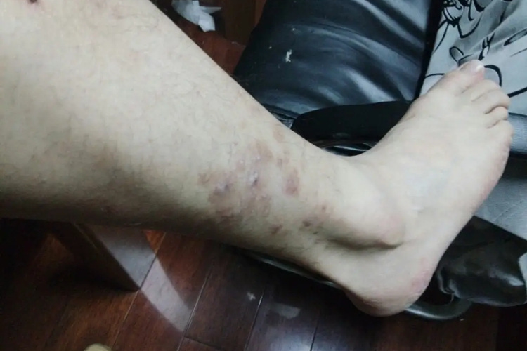 小腿慢性湿疹图