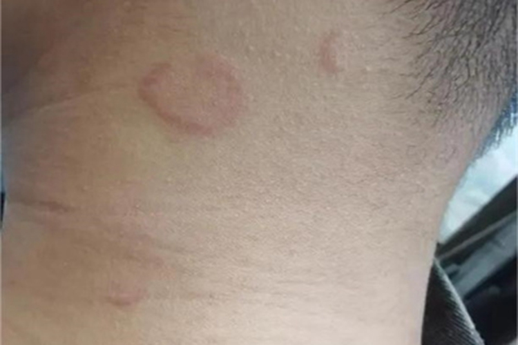 毛细血管扩张性环状紫癜红斑图