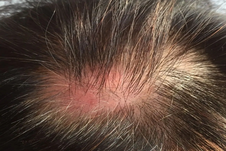 红斑狼疮头发稀少图