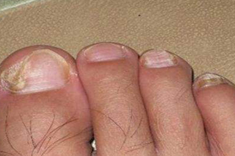 反甲脚趾甲增生图