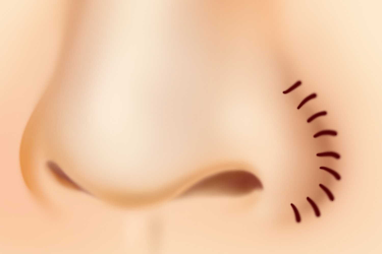 鼻翼缩小后第三天图