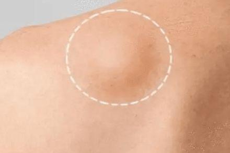 风寒外袭无名肿毒皮色不变图