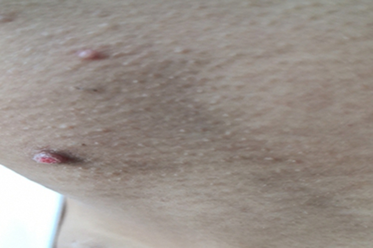 寻常疣大腿根长小肉球图 寻常疣大腿根长小肉球图