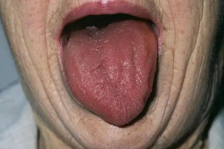 肝肾阴虚证舌苔图