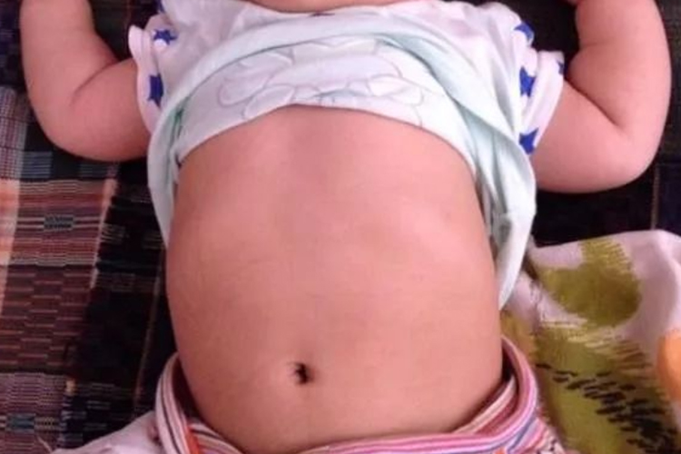 婴儿先天胸壁畸形图