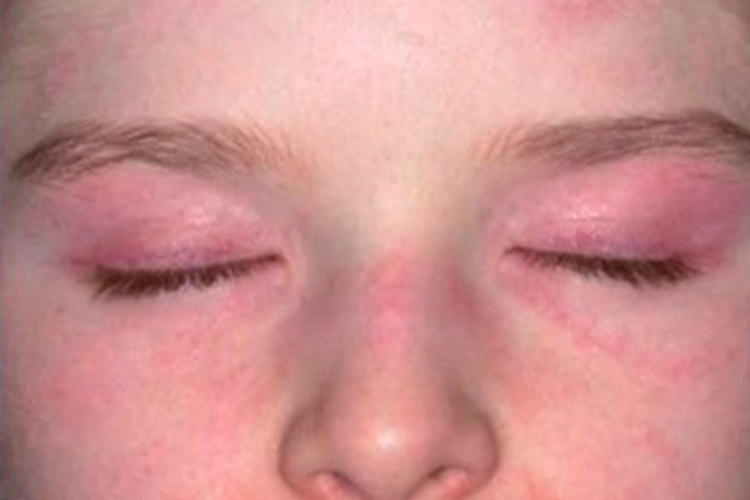 幼年型皮肌炎眼睑皮肤发紫图