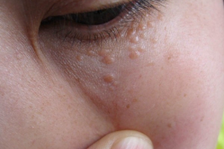 汗腺瘤眼睑淡粉色丘疹图 汗腺瘤眼睑淡粉色丘疹图