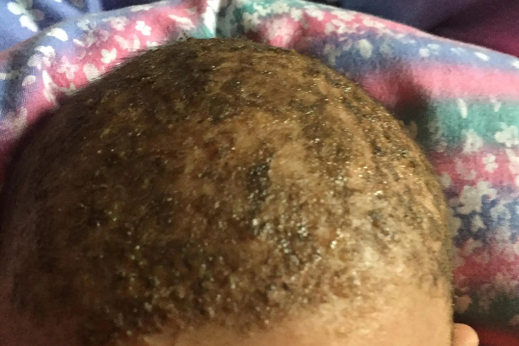 三个月宝宝头上脂溢性湿疹图 三个月宝宝头上脂溢性湿疹图