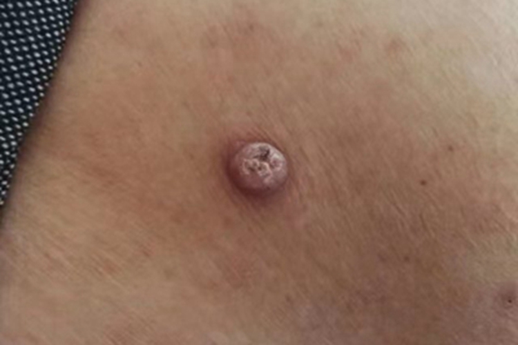 寻常疣大腿症状图 寻常疣大腿症状图