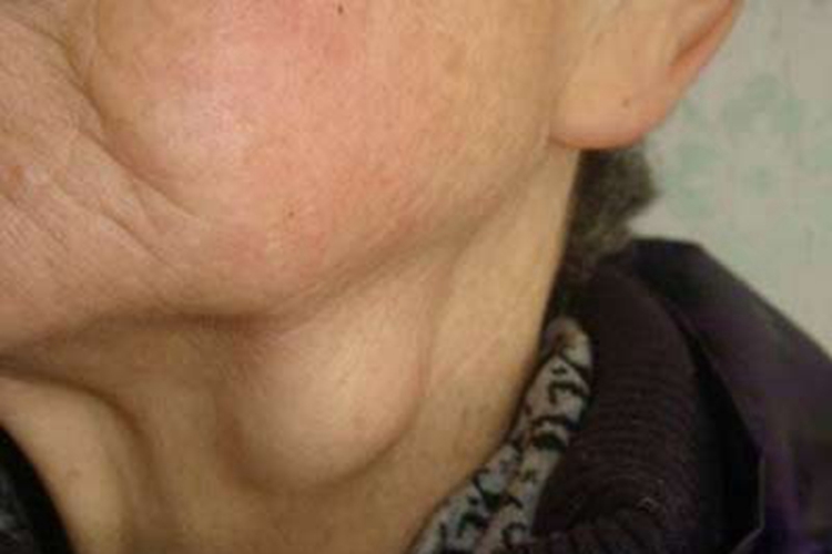 皮肤型组织胞浆菌病侧颈症状图