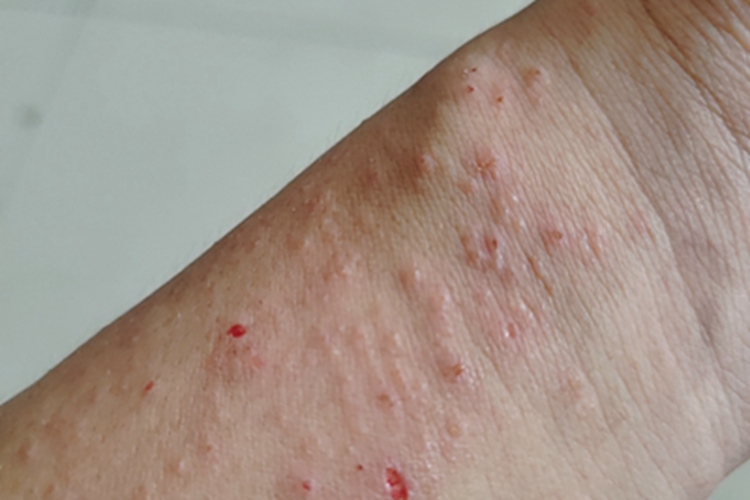 急性单纯性痒疹手腕症状图