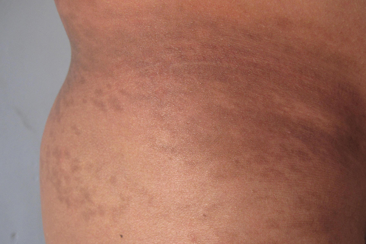 炎症后色素沉着后腰发黑图