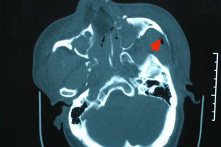 上颌骨骨折影像图